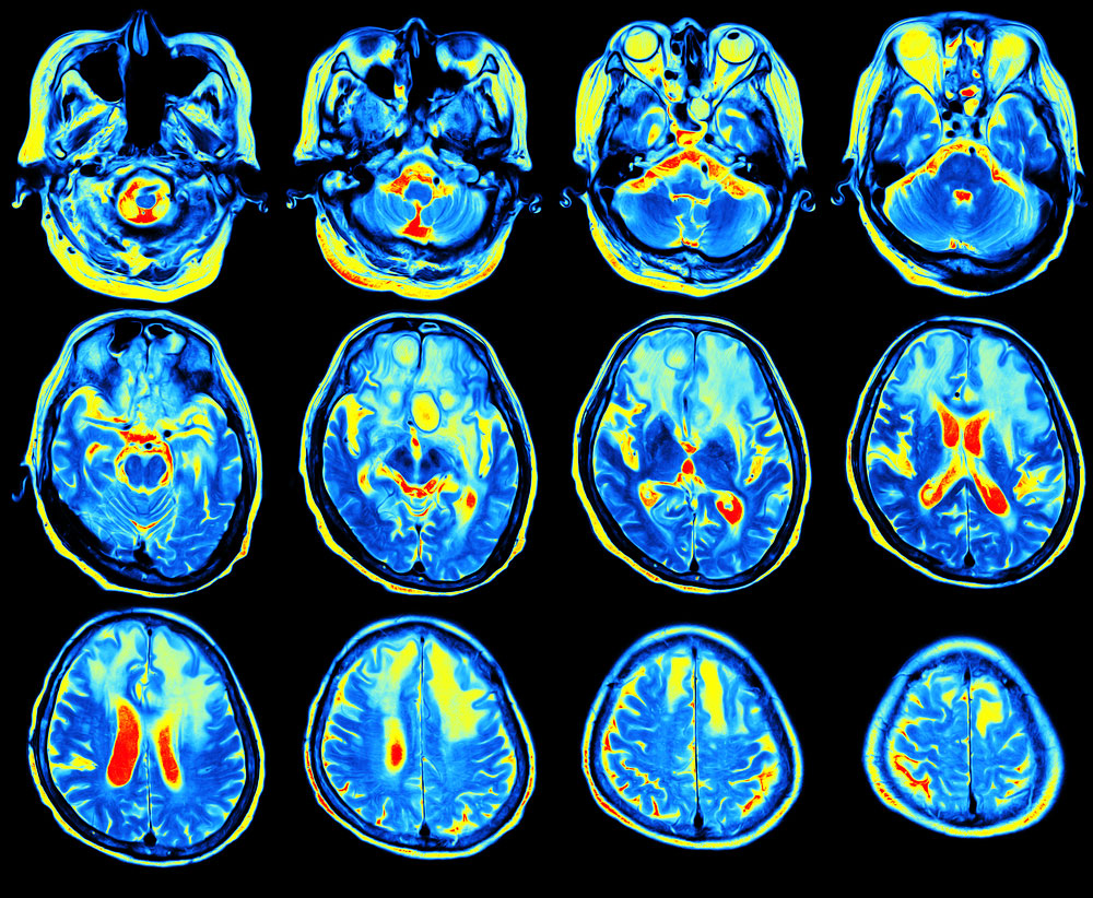 Functional MRI used to investigate new drugs for drug relapse prevention